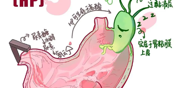 【必看】幽門螺桿菌真相揭示，別再忽視你的胃痛了！